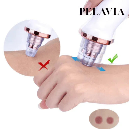 Removedor de Cravos a Vácuo - Pelavia®